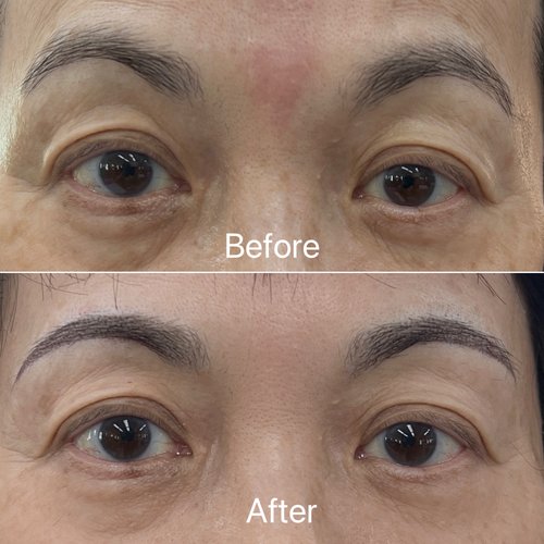 Brow before and after